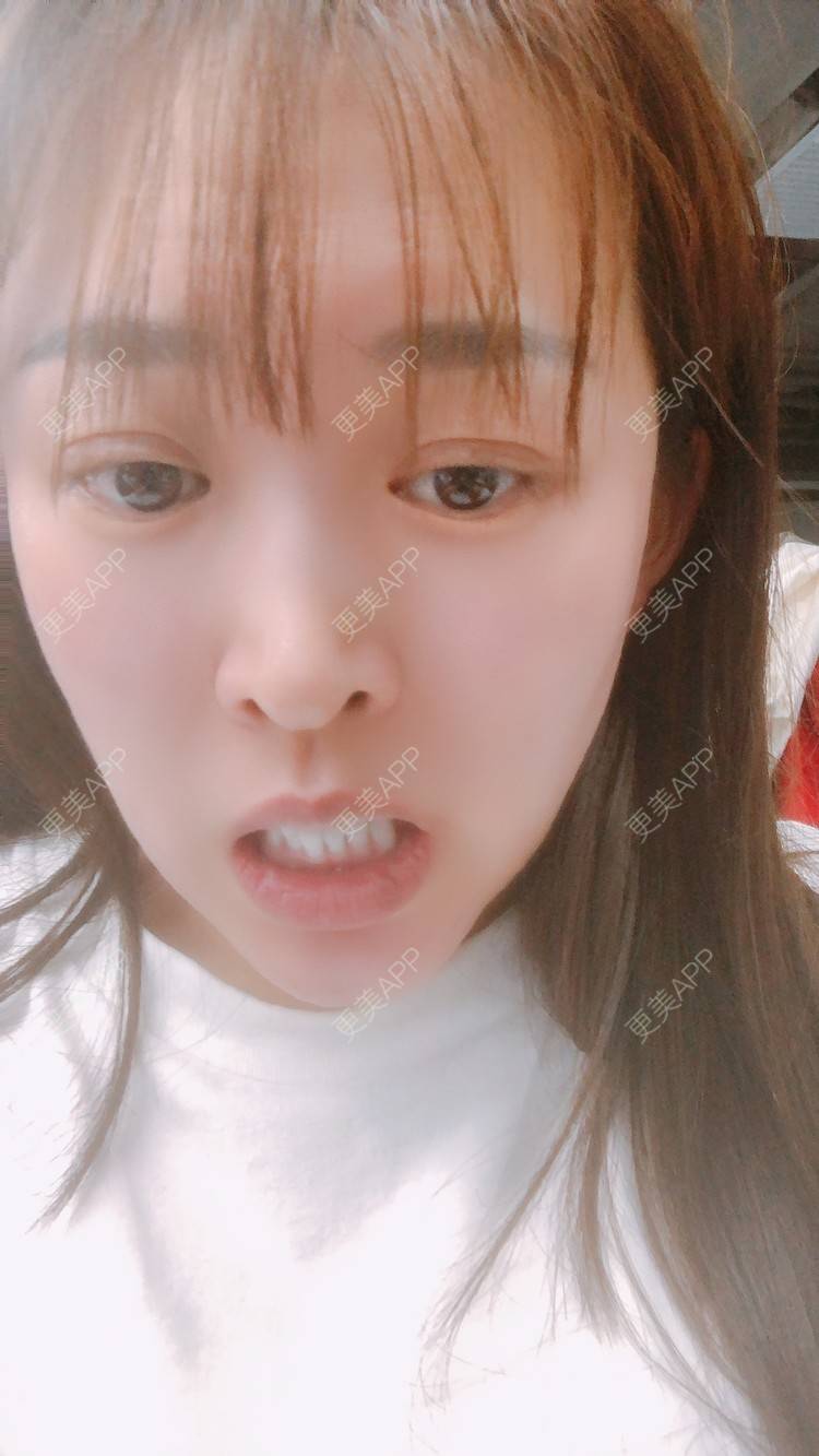 更美 - 更美用户nOSa2OXrxm的冷光美白经验 | 北京 | 冷光美白