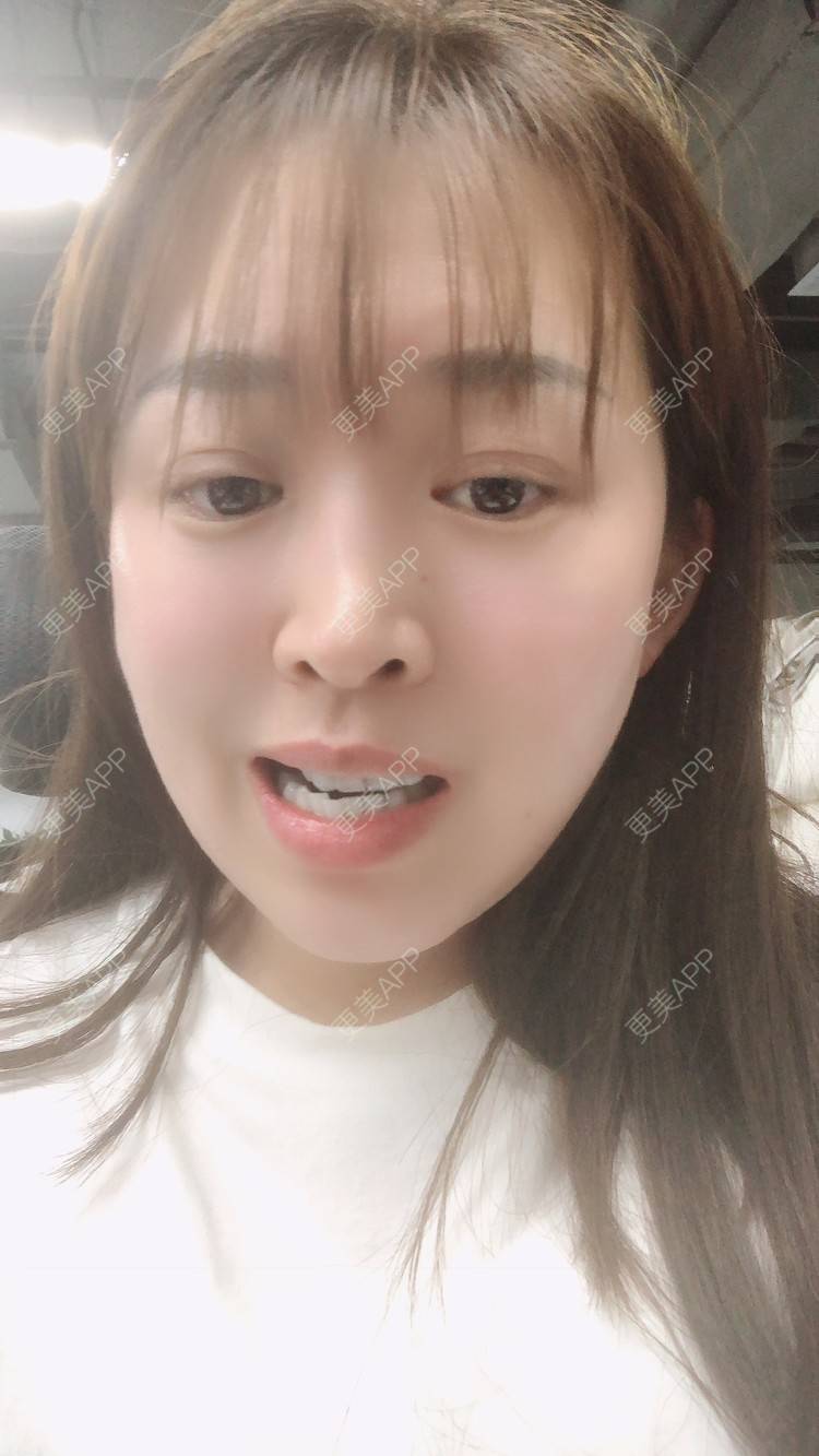 更美 - 更美用户nOSa2OXrxm的冷光美白经验 | 北京 | 冷光美白
