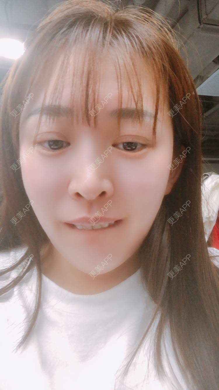 更美 - 更美用户nOSa2OXrxm的冷光美白经验 | 北京 | 冷光美白