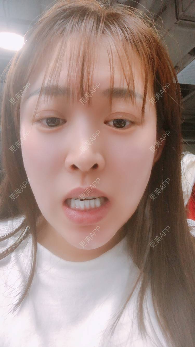 更美 - 更美用户nOSa2OXrxm的冷光美白经验 | 北京 | 冷光美白