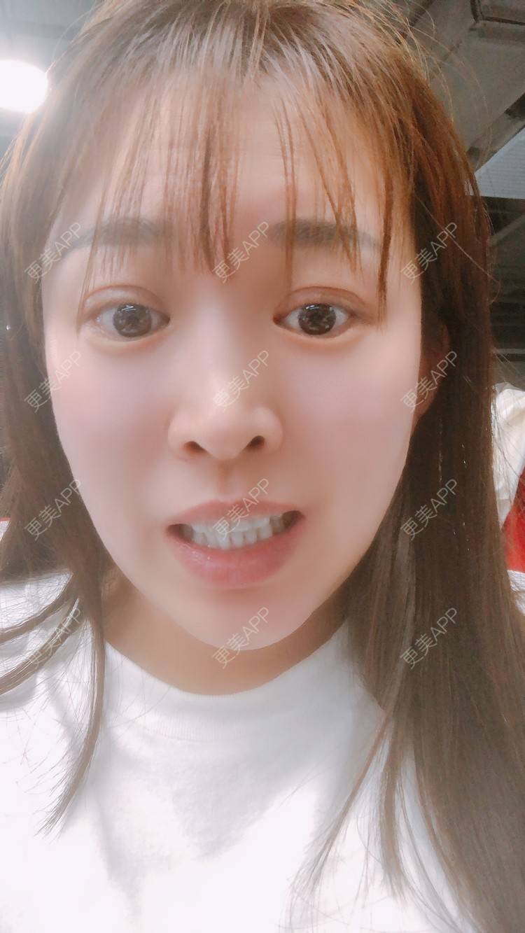 更美 - 更美用户nOSa2OXrxm的冷光美白经验 | 北京 | 冷光美白