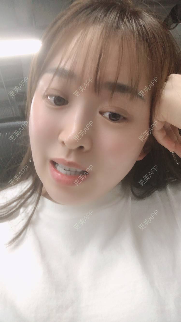 更美 - 更美用户nOSa2OXrxm的冷光美白经验 | 北京 | 冷光美白