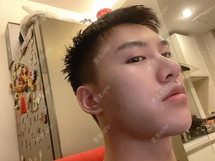 更美 - 晓明a的玻尿酸鼻部经验 | 玻尿酸下巴 | 玻尿酸鼻部 | 杭州