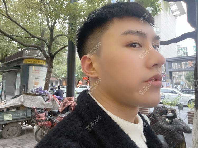 更美 - 晓明a的玻尿酸鼻部经验 | 玻尿酸下巴 | 玻尿酸鼻部 | 杭州