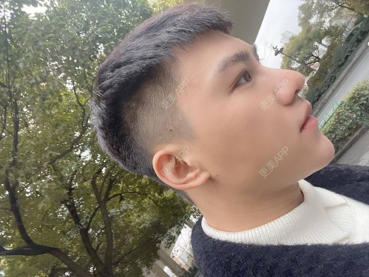 更美 - 晓明a的玻尿酸鼻部经验 | 玻尿酸下巴 | 玻尿酸鼻部 | 杭州