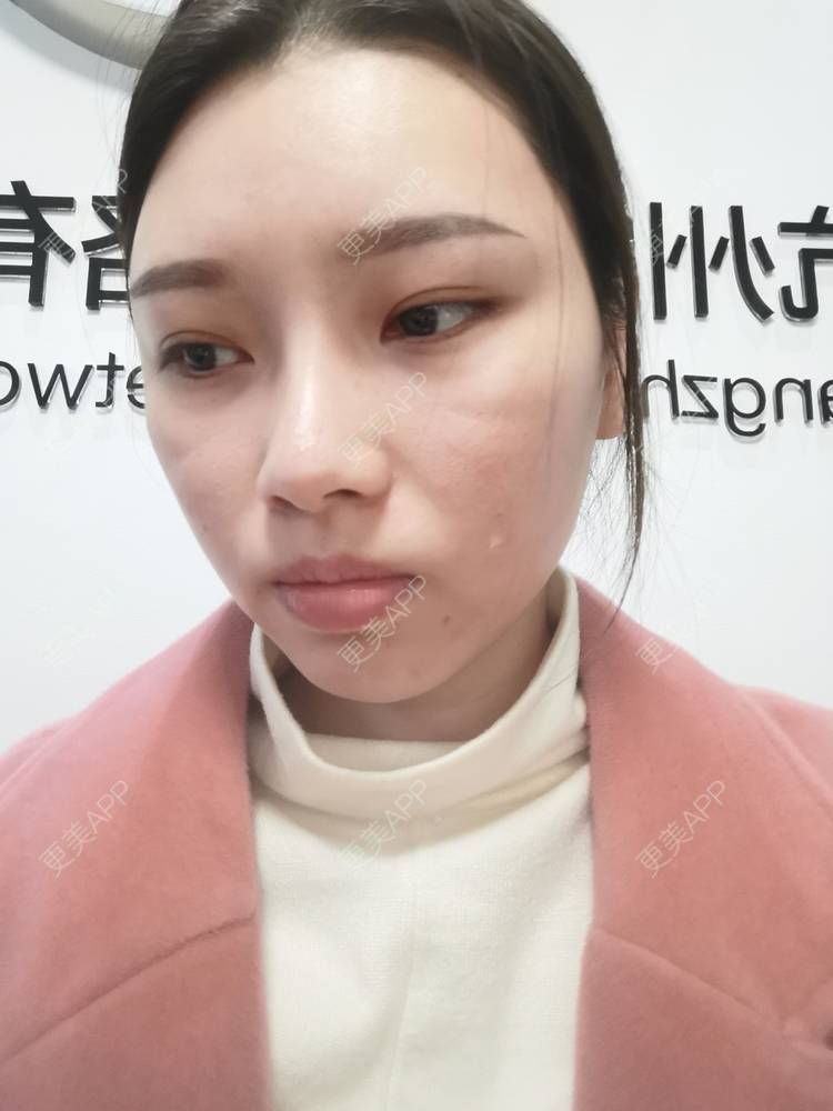 更美 - 更美用户82701801的隐形牙齿矫正经验 | 杭州