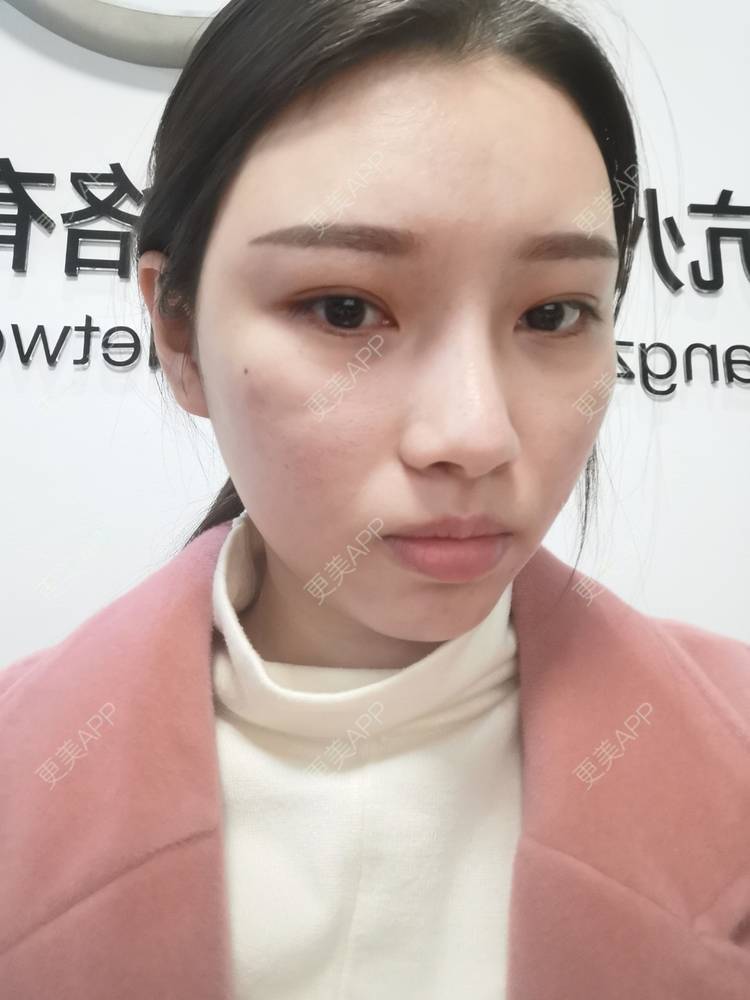 更美 - 更美用户82701801的隐形牙齿矫正经验 | 杭州