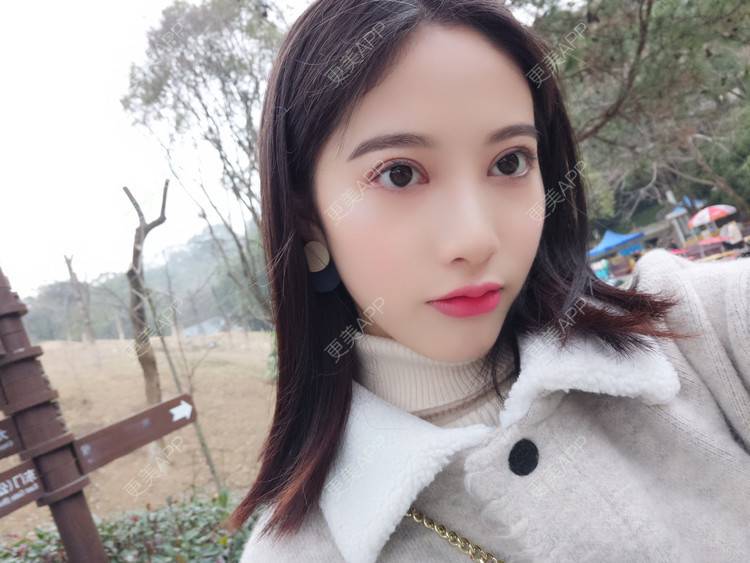 更美 - 美哒哒的婷怪咖的全切双眼皮经验 | 视频日记 | 全切双眼皮 | 重庆