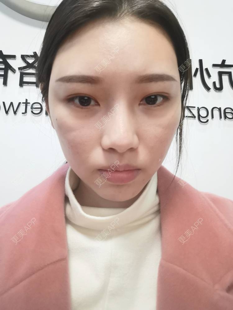 更美 - 更美用户82701801的隐形牙齿矫正经验 | 杭州