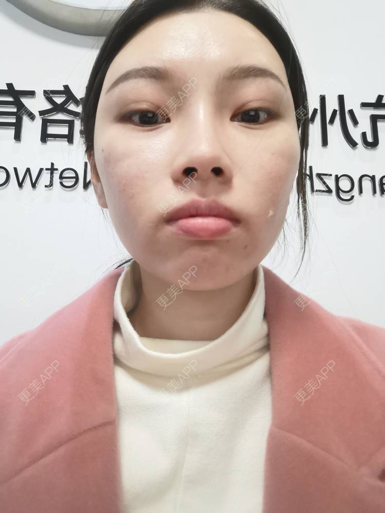 更美 - 更美用户82701801的隐形牙齿矫正经验 | 杭州