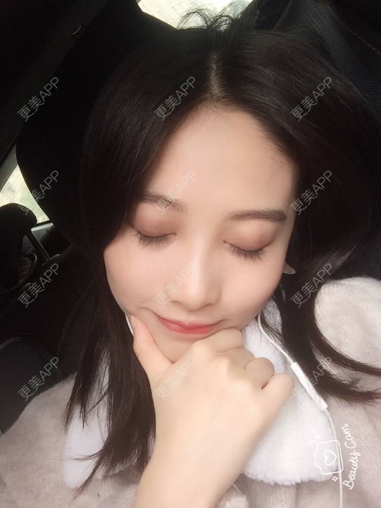 更美 - 美哒哒的婷怪咖的全切双眼皮经验 | 视频日记 | 全切双眼皮 | 重庆