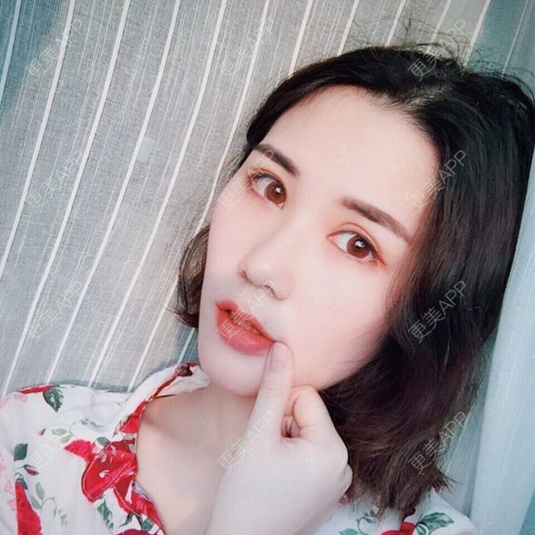 更美 - 我会有猫的i的双眼皮经验 | 视频日记 | 双眼皮 | 重庆