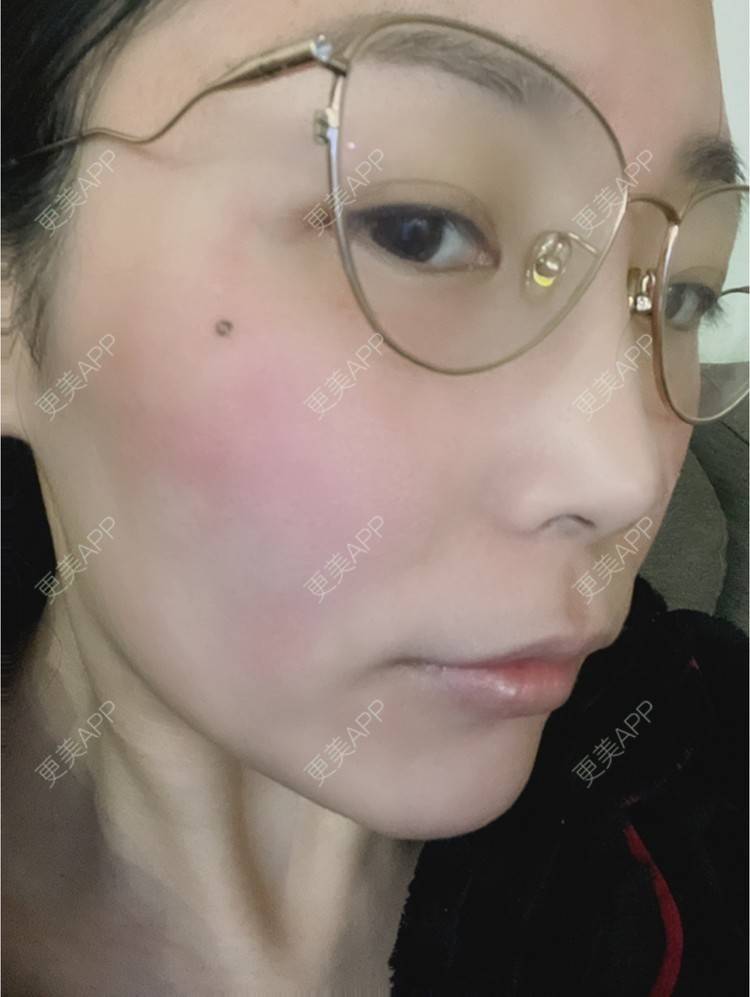 更美 - 橘子ʕ๑•ɷ•๑ʔ❀的玻尿酸鼻部经验 | 玻尿酸鼻部 | 西安 | 玻尿酸鼻基底