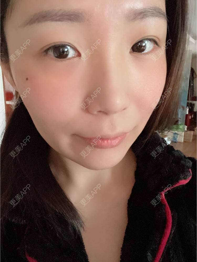更美 - 橘子ʕ๑•ɷ•๑ʔ❀的玻尿酸法令纹经验 | 西安 | 玻尿酸法令纹