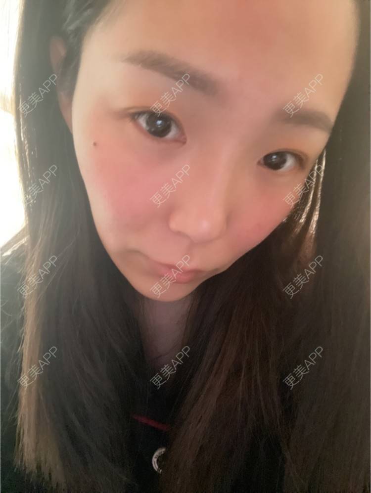 更美 - 橘子ʕ๑•ɷ•๑ʔ❀的玻尿酸法令纹经验 | 西安 | 玻尿酸法令纹
