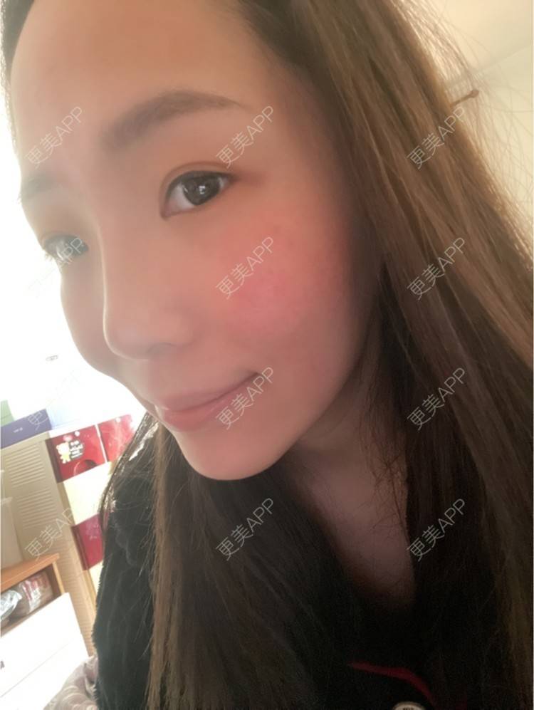 更美 - 橘子ʕ๑•ɷ•๑ʔ❀的玻尿酸法令纹经验 | 西安 | 玻尿酸法令纹