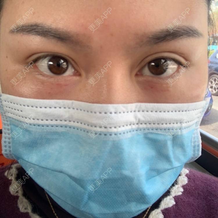 更美 - 更美用户XZl9FM68Hc的玻尿酸颈纹经验 | 玻尿酸颈纹 | 东莞