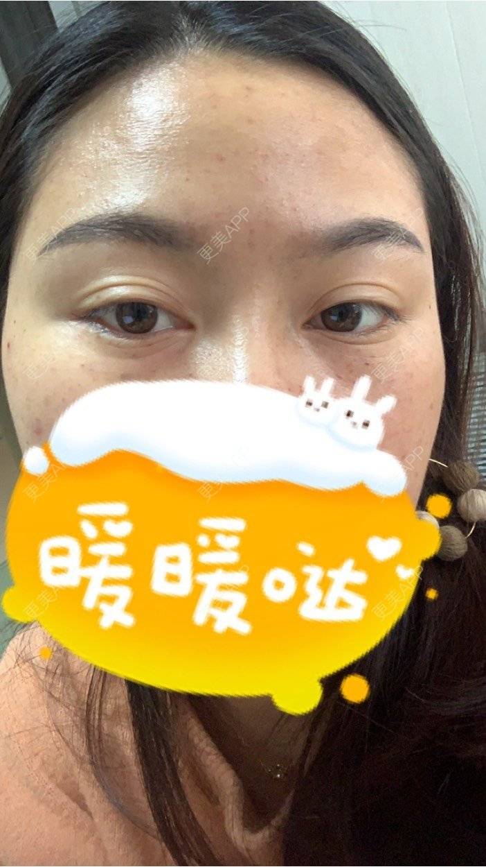 更美 - 更美用户XZl9FM68Hc的玻尿酸颈纹经验 | 玻尿酸颈纹 | 东莞