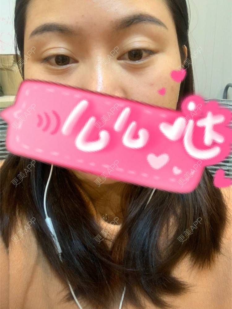 更美 - 更美用户XZl9FM68Hc的玻尿酸颈纹经验 | 玻尿酸颈纹 | 东莞