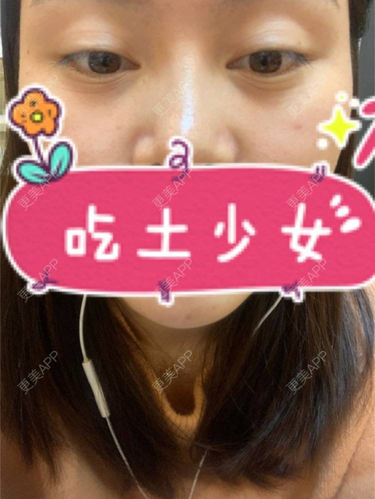 更美 - 更美用户XZl9FM68Hc的玻尿酸颈纹经验 | 玻尿酸颈纹 | 东莞
