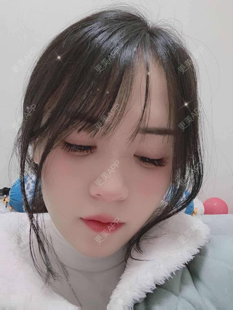 更美 - 草莓味之夏的双眼皮经验 | 眼部多项 | 广州 | 视频日记 | 双眼皮