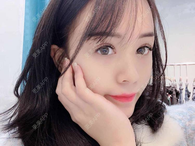 更美 - 草莓味之夏的双眼皮经验 | 眼部多项 | 广州 | 视频日记 | 双眼皮