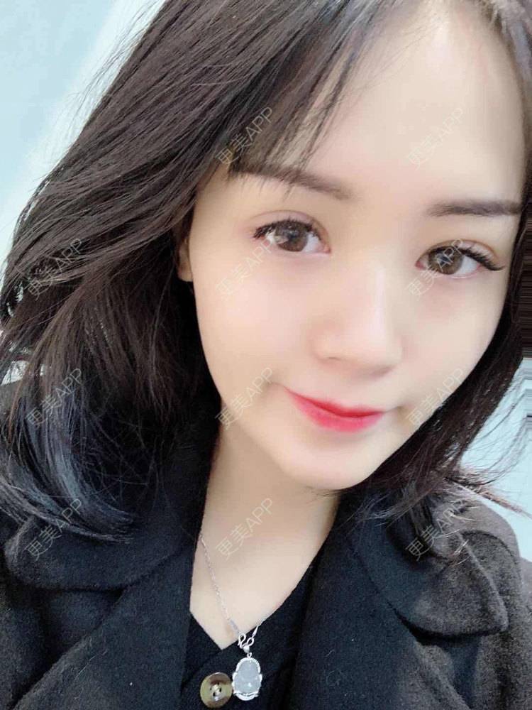 更美 - 草莓味之夏的双眼皮经验 | 眼部多项 | 广州 | 视频日记 | 双眼皮