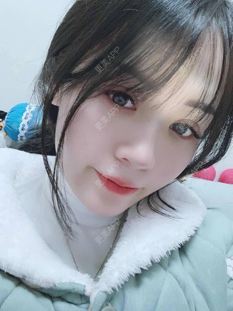 更美 - 草莓味之夏的双眼皮经验 | 眼部多项 | 广州 | 视频日记 | 双眼皮