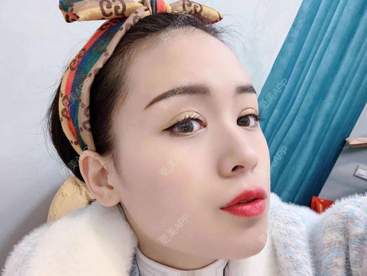 更美 - 草莓味之夏的双眼皮经验 | 眼部多项 | 广州 | 视频日记 | 双眼皮