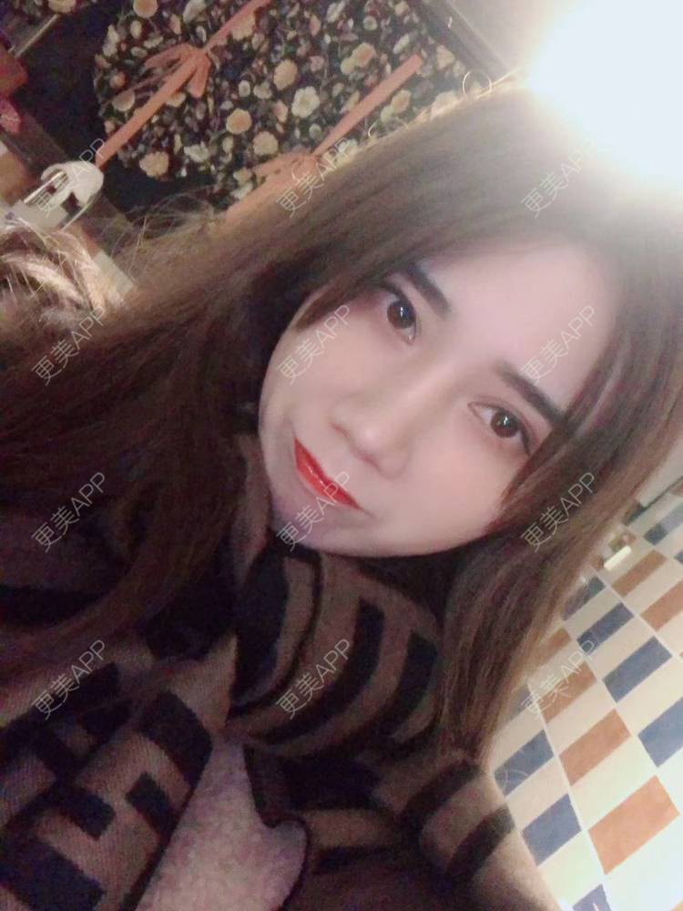 更美 - 半个柚子不加C的隆鼻经验 | 鼻中隔软骨隆鼻 | 肋软骨隆鼻 | 鼻翼缩小 | 鼻小柱延长 | 鼻部多项 | 隆鼻 | 自体软骨垫鼻尖 | 鼻中隔软骨垫鼻头 | 耳软骨隆鼻