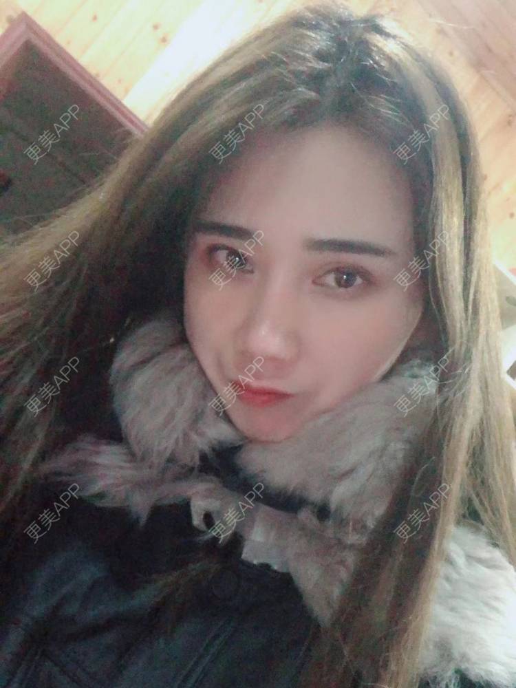 更美 - 半个柚子不加C的隆鼻经验 | 鼻中隔软骨隆鼻 | 肋软骨隆鼻 | 鼻翼缩小 | 鼻小柱延长 | 鼻部多项 | 隆鼻 | 自体软骨垫鼻尖 | 鼻中隔软骨垫鼻头 | 耳软骨隆鼻