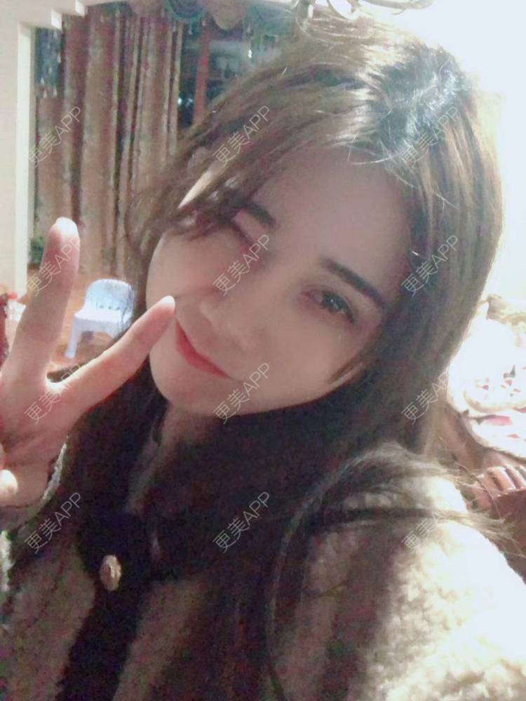 更美 - 半个柚子不加C的隆鼻经验 | 鼻中隔软骨隆鼻 | 肋软骨隆鼻 | 鼻翼缩小 | 鼻小柱延长 | 鼻部多项 | 隆鼻 | 自体软骨垫鼻尖 | 鼻中隔软骨垫鼻头 | 耳软骨隆鼻