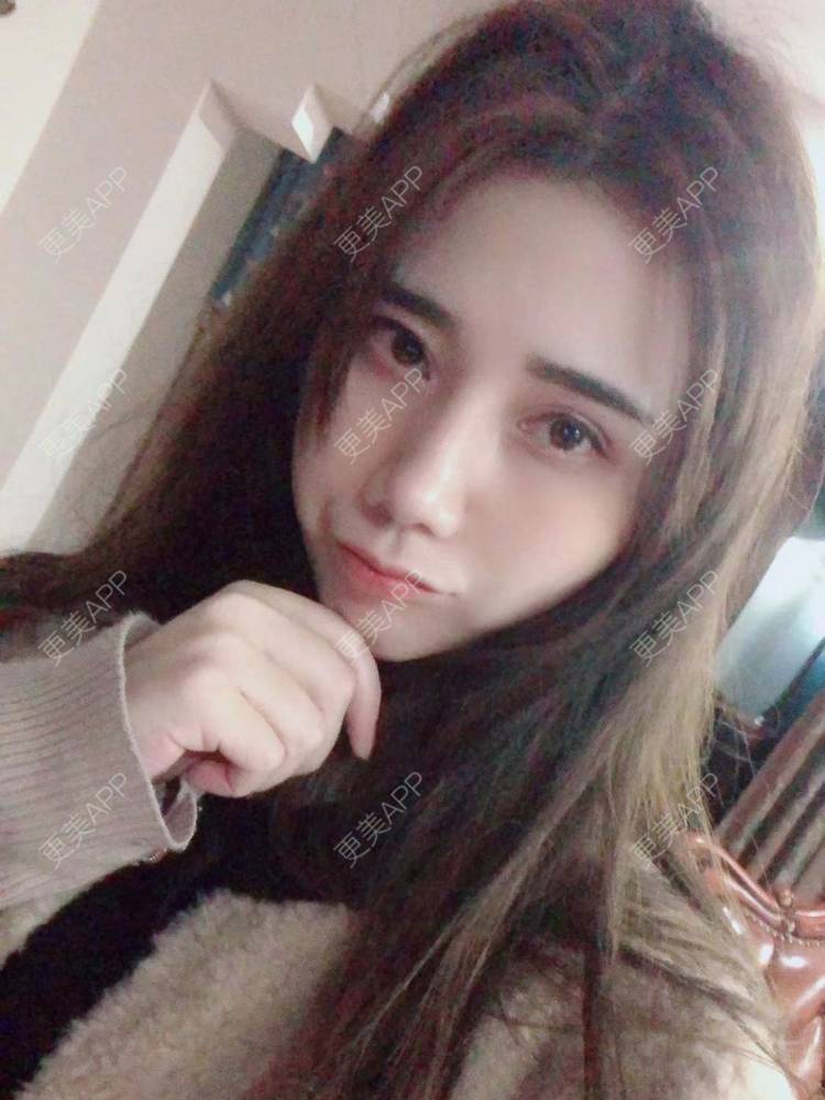 更美 - 半个柚子不加C的隆鼻经验 | 鼻中隔软骨隆鼻 | 肋软骨隆鼻 | 鼻翼缩小 | 鼻小柱延长 | 鼻部多项 | 隆鼻 | 自体软骨垫鼻尖 | 鼻中隔软骨垫鼻头 | 耳软骨隆鼻