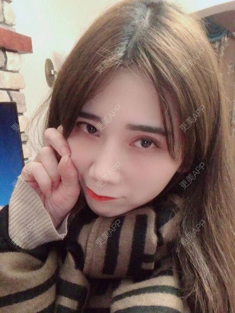 更美 - 半个柚子不加C的隆鼻经验 | 鼻中隔软骨隆鼻 | 肋软骨隆鼻 | 鼻翼缩小 | 鼻小柱延长 | 鼻部多项 | 隆鼻 | 自体软骨垫鼻尖 | 鼻中隔软骨垫鼻头 | 耳软骨隆鼻