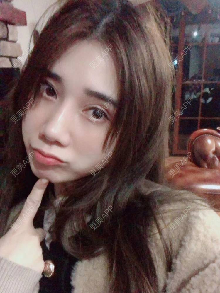 更美 - 半个柚子不加C的隆鼻经验 | 鼻中隔软骨隆鼻 | 肋软骨隆鼻 | 鼻翼缩小 | 鼻小柱延长 | 鼻部多项 | 隆鼻 | 自体软骨垫鼻尖 | 鼻中隔软骨垫鼻头 | 耳软骨隆鼻
