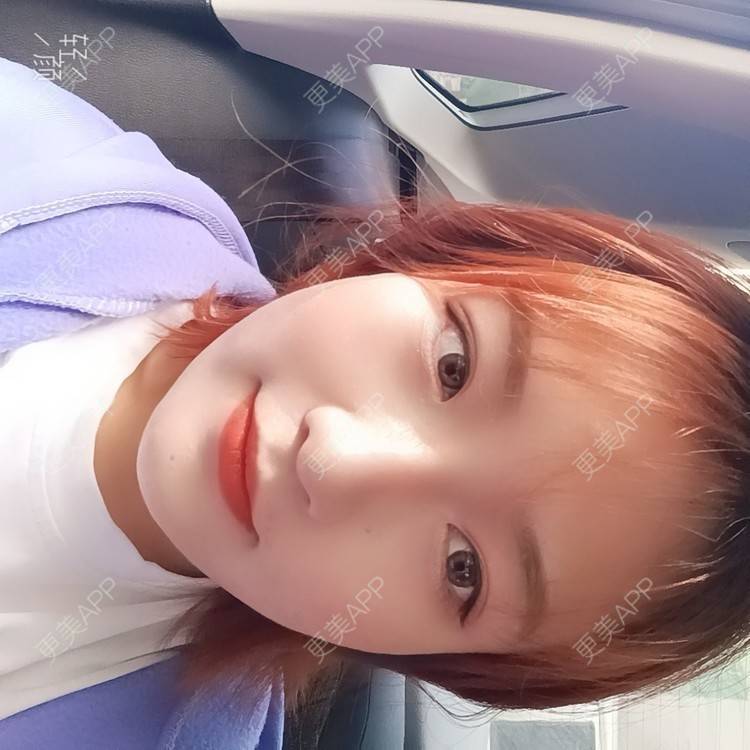 更美 - 更美用户tbs28rKiLZ的玻尿酸卧蚕经验 | 玻尿酸卧蚕 | 杭州