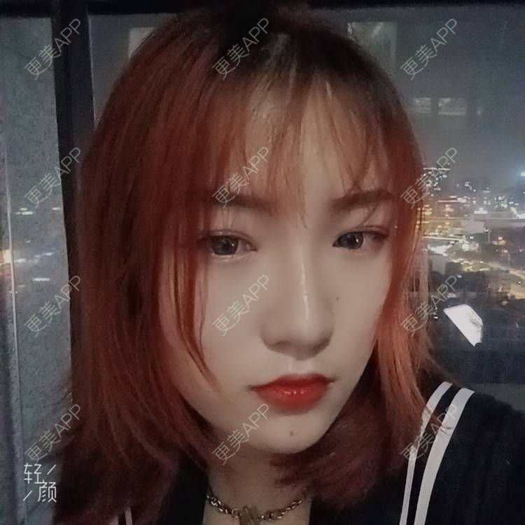 更美 - 更美用户tbs28rKiLZ的玻尿酸卧蚕经验 | 玻尿酸卧蚕 | 杭州