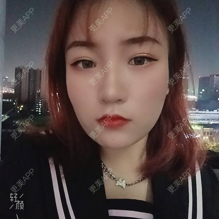 更美 - 更美用户tbs28rKiLZ的玻尿酸卧蚕经验 | 玻尿酸卧蚕 | 杭州