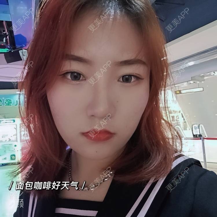 更美 - 更美用户tbs28rKiLZ的玻尿酸卧蚕经验 | 玻尿酸卧蚕 | 杭州