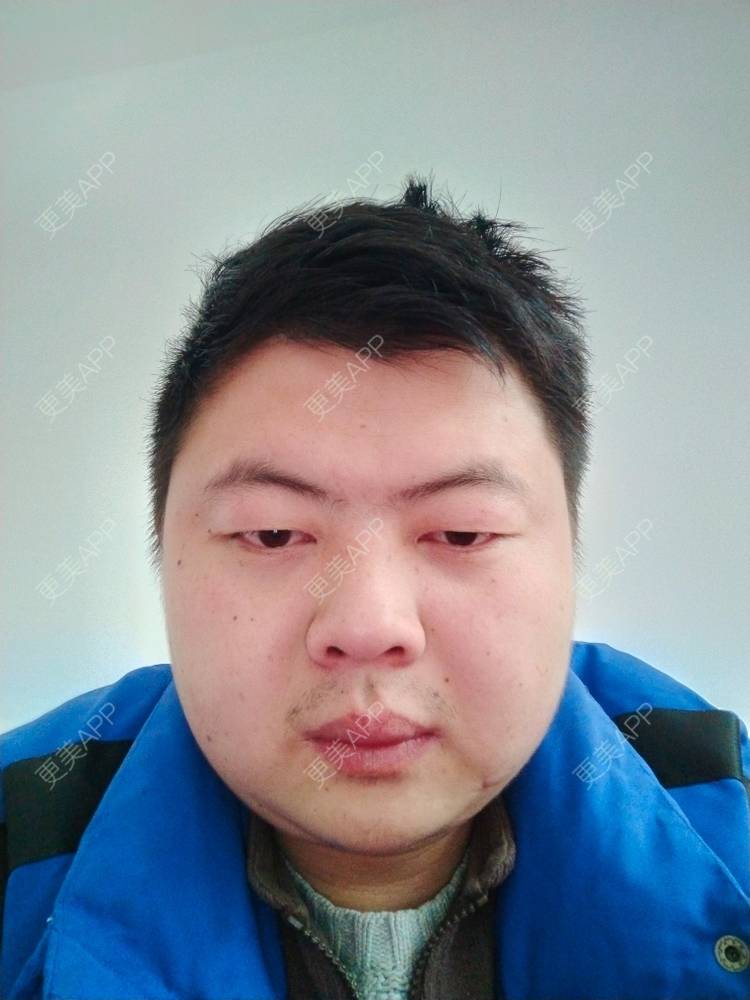 更美 - 更美用户IxBJbwOEyA的除皱瘦脸经验 | 除皱瘦脸 | 苏州