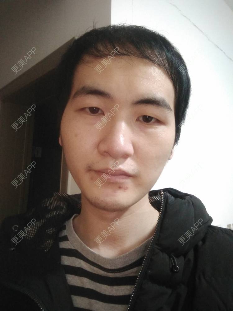更美 - 更美用户wHSFRCieMm的植胡须经验 | 武汉 | 植胡须