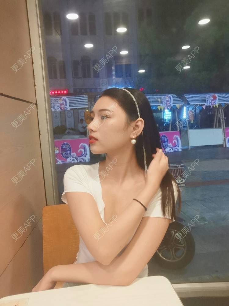 更美 - 更美用户82701801的隐形牙齿矫正经验 | 杭州