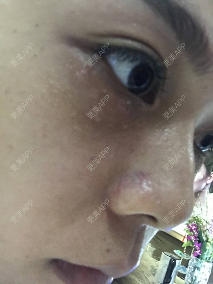 更美 - 更美用户3dX0USczfv的激光去脂肪粒经验 | 肤质检测 | 激光去脂肪粒 | 武汉