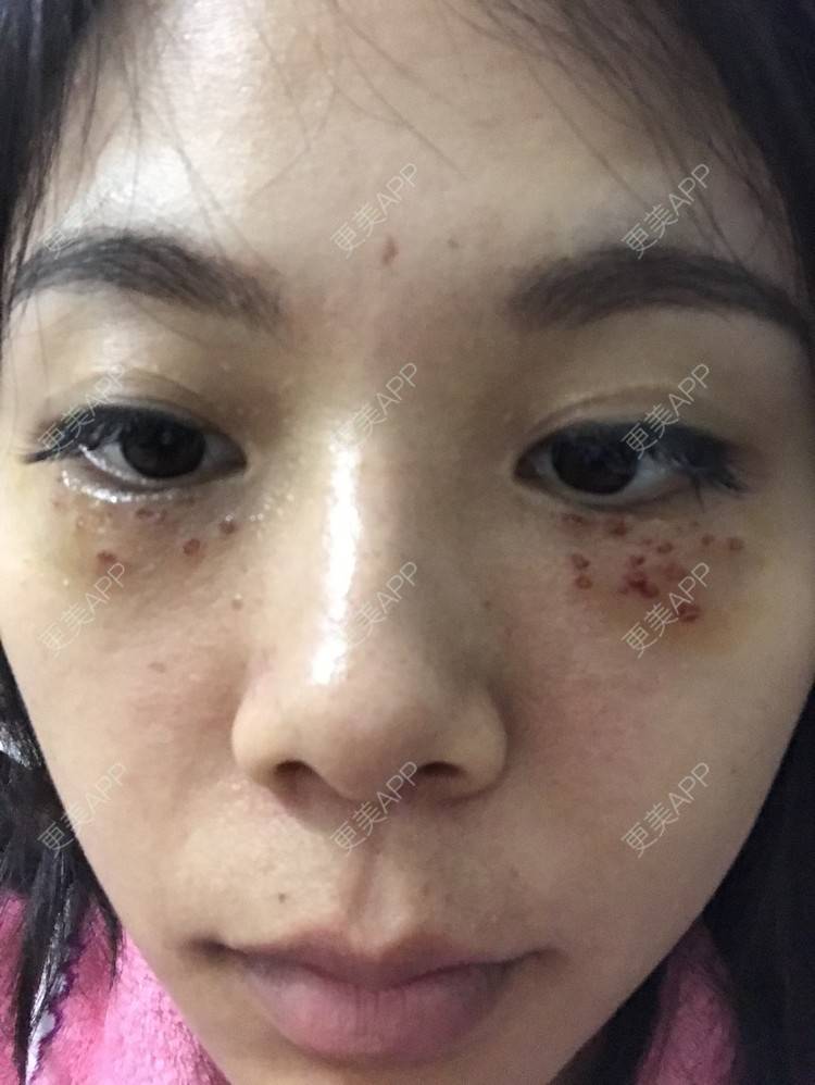 更美 - 更美用户3dX0USczfv的激光去脂肪粒经验 | 肤质检测 | 激光去脂肪粒 | 武汉