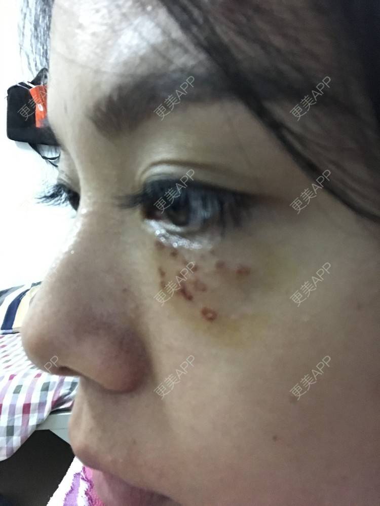更美 - 更美用户3dX0USczfv的激光去脂肪粒经验 | 肤质检测 | 激光去脂肪粒 | 武汉