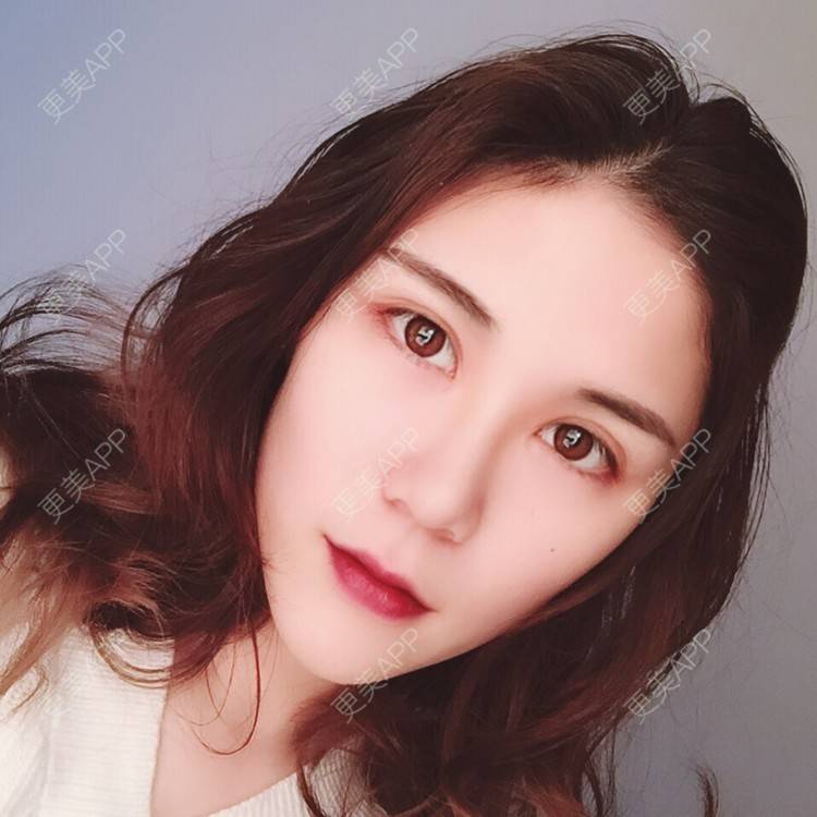 更美 - 我会有猫的i的双眼皮经验 | 视频日记 | 双眼皮 | 重庆