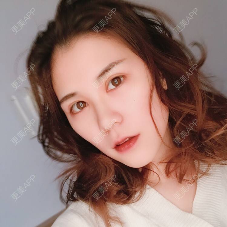 更美 - 我会有猫的i的双眼皮经验 | 视频日记 | 双眼皮 | 重庆