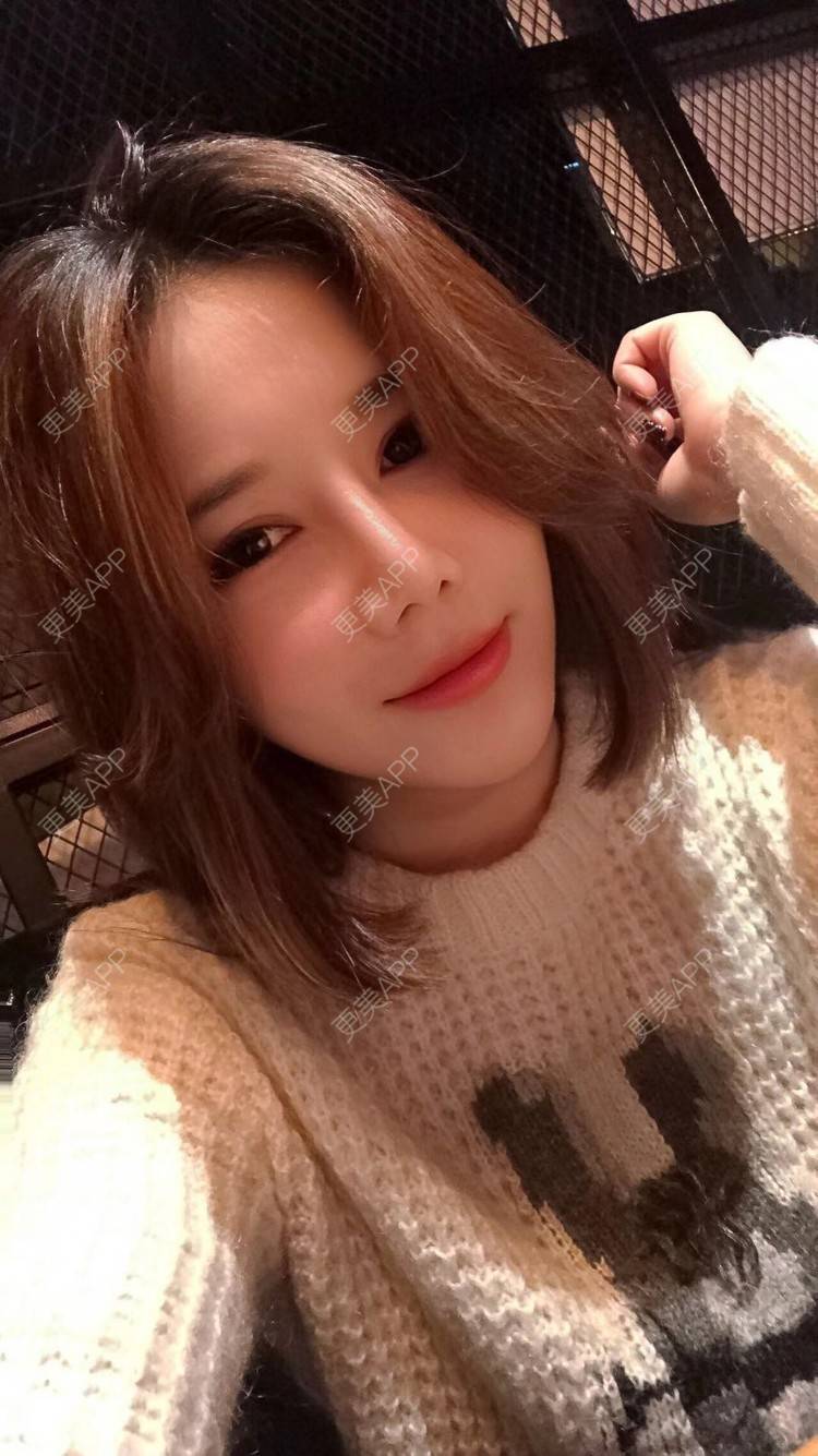 更美 - 娇滴滴的你的自体脂肪丰苹果肌经验 | 自体脂肪全面部填充 | 重庆 | 自体脂肪丰太阳穴 | 自体脂肪丰面颊 | 自体脂肪丰苹果肌 | 自体脂肪垫下巴