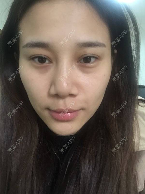 更美 - 娇滴滴的你的自体脂肪丰苹果肌经验 | 自体脂肪全面部填充 | 重庆 | 自体脂肪丰太阳穴 | 自体脂肪丰面颊 | 自体脂肪丰苹果肌 | 自体脂肪垫下巴