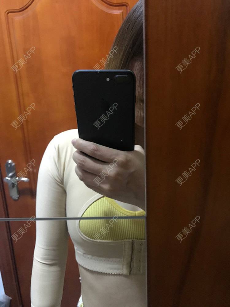 更美 - 更美用户he4cSABruG的手臂吸脂经验 | 手臂吸脂 | 广州